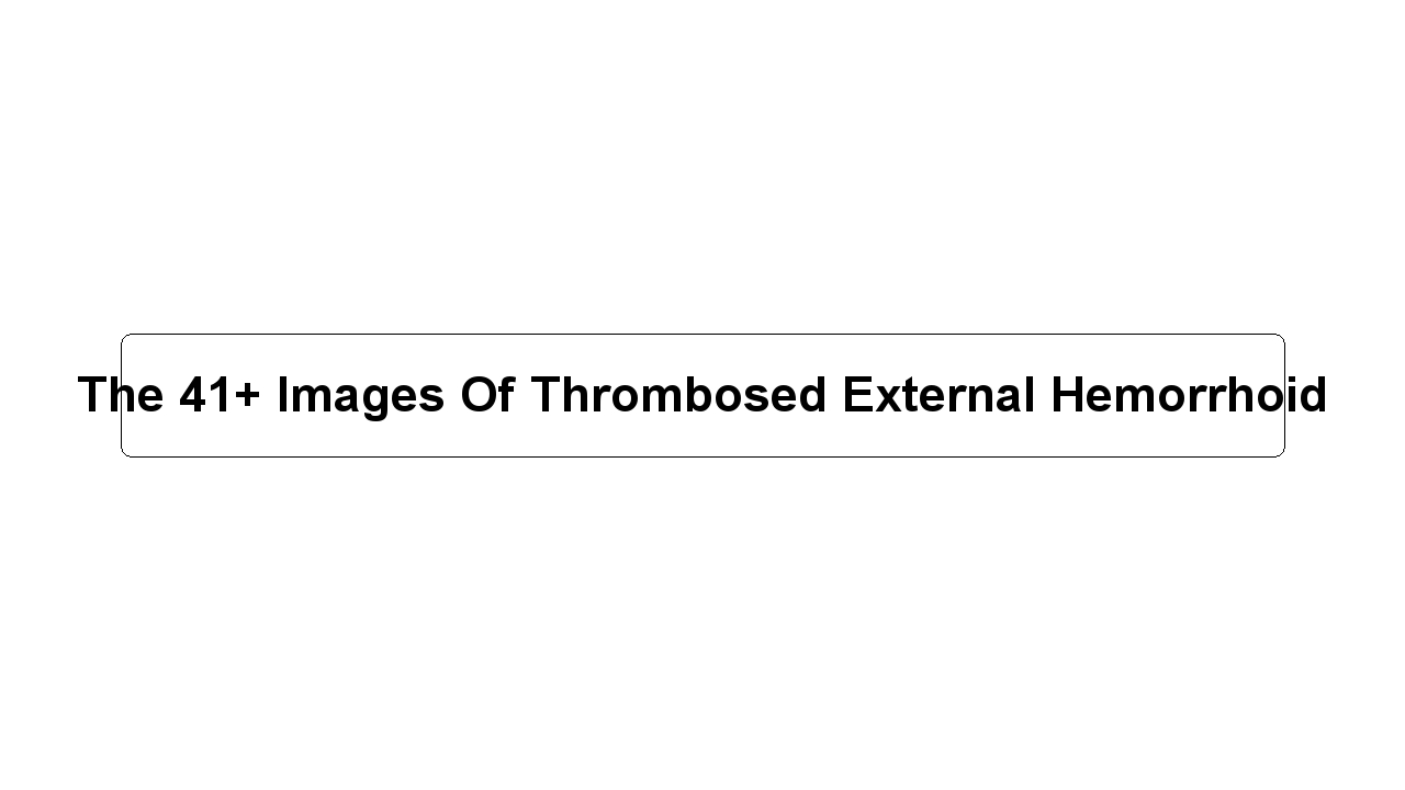 The 41+ Images Of Thrombosed External Hemorrhoid