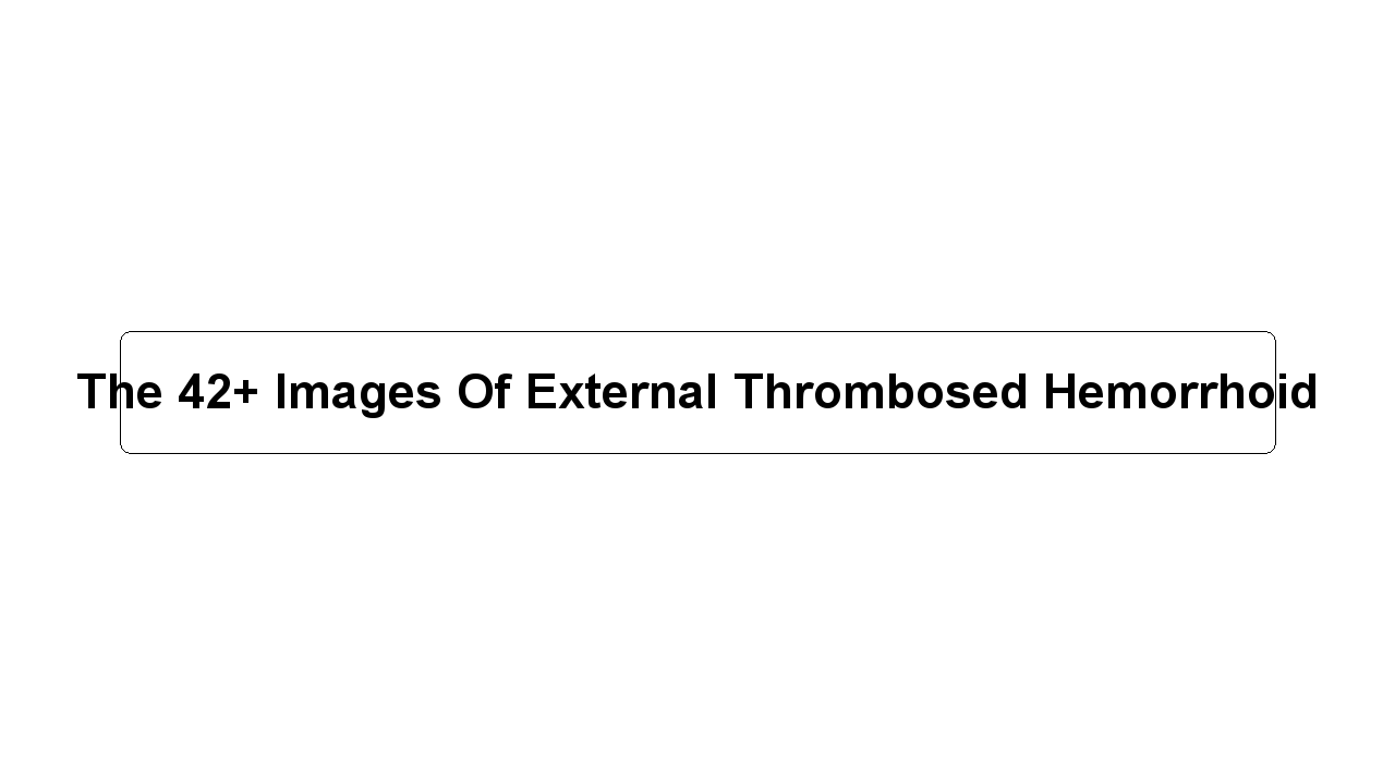 The 42+ Images Of External Thrombosed Hemorrhoid