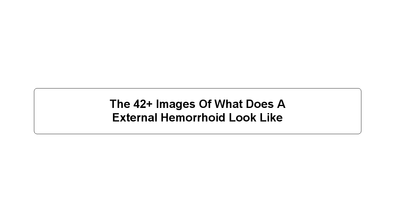 The 42+ Images Of What Does A External Hemorrhoid Look Like