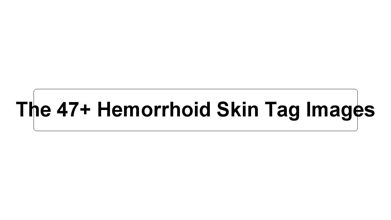 The 47+ Hemorrhoid Skin Tag Images