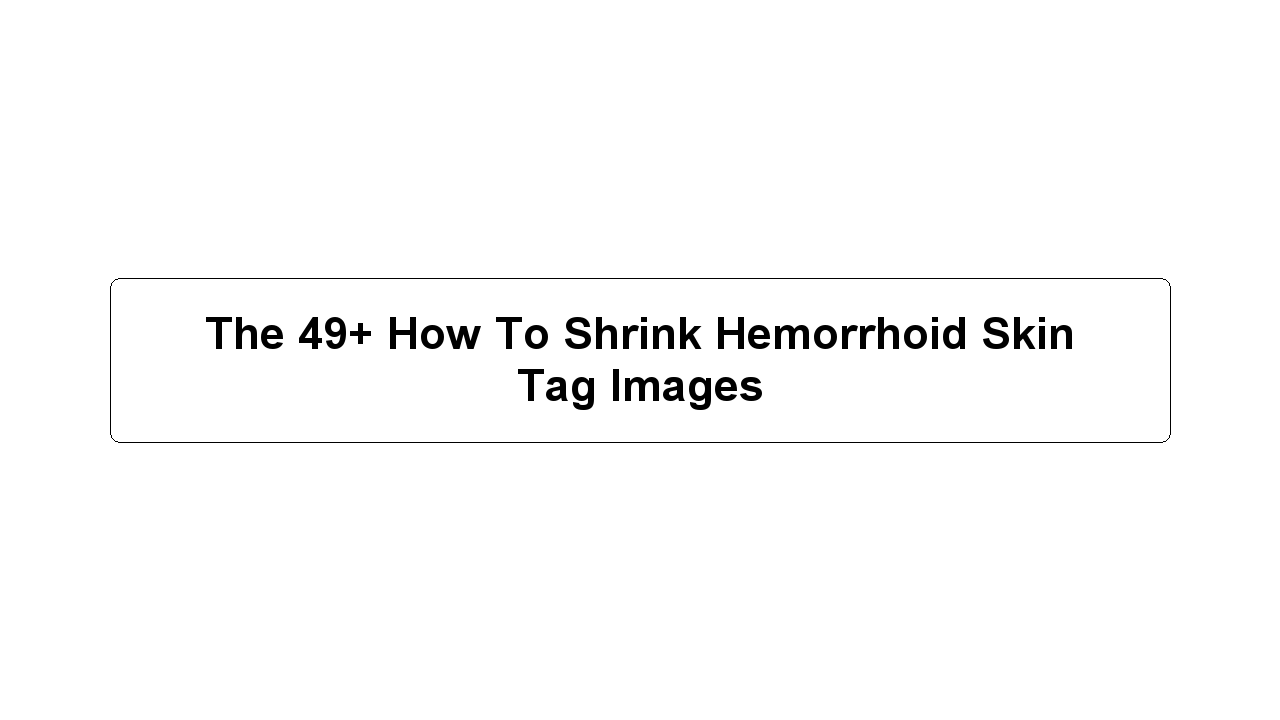 The 49+ How To Shrink Hemorrhoid Skin Tag Images