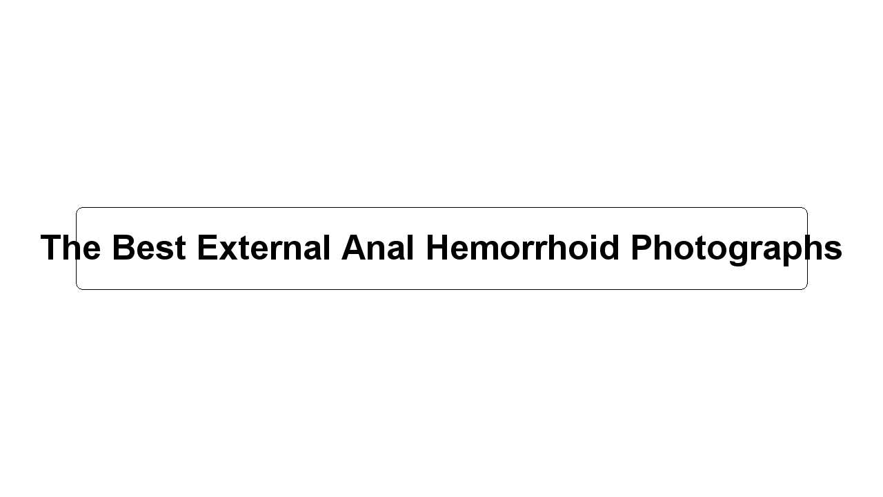 The Best External Anal Hemorrhoid Photographs