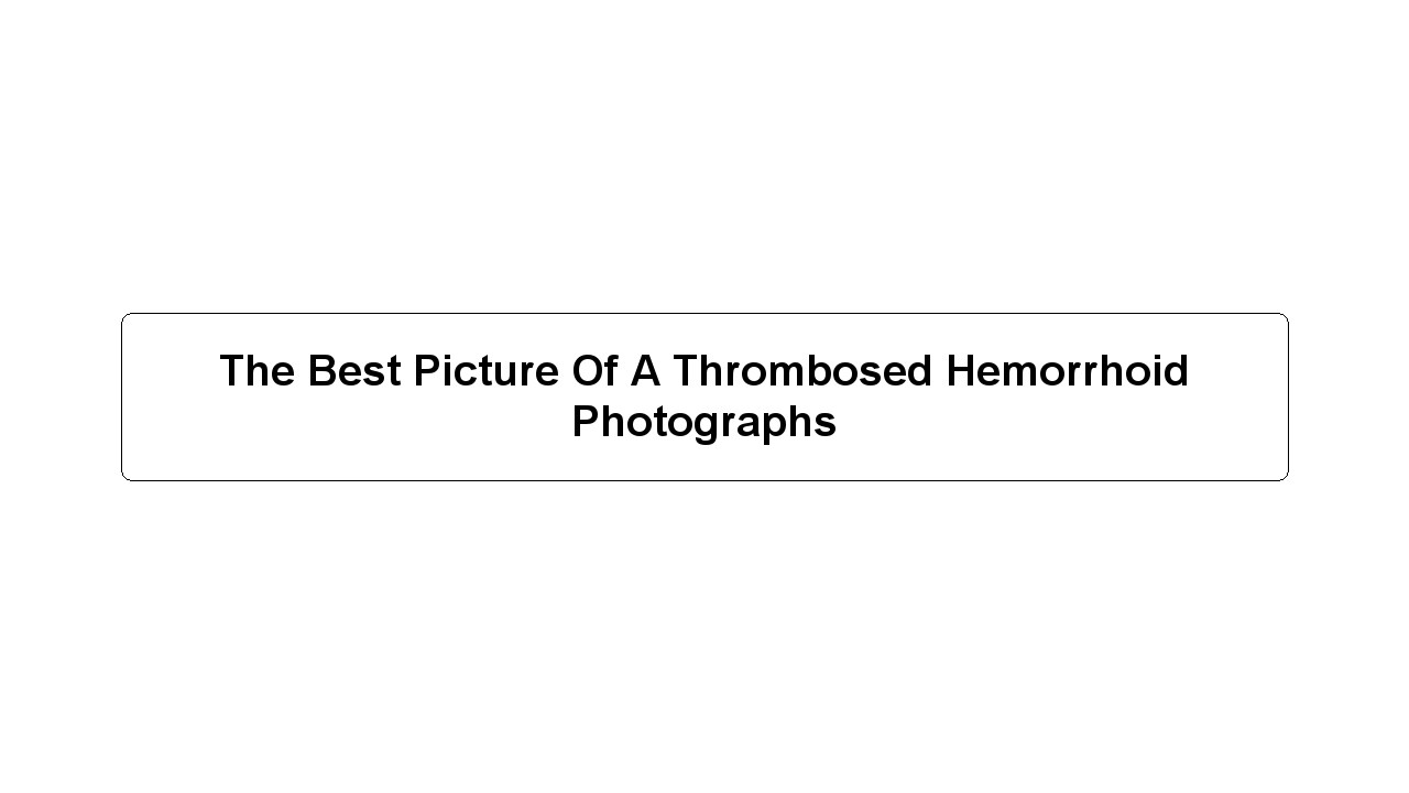 The Best Picture Of A Thrombosed Hemorrhoid Photographs